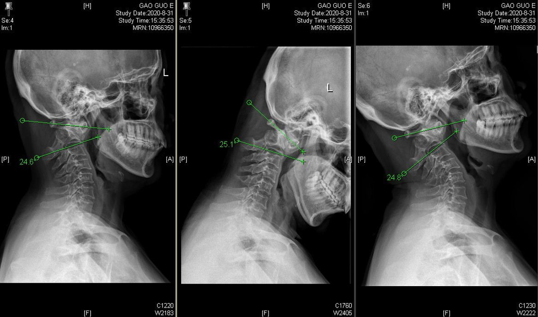 颈椎x光片显示在侧位和前屈,后仰位,寰枢椎之间的位置关系无明显变化