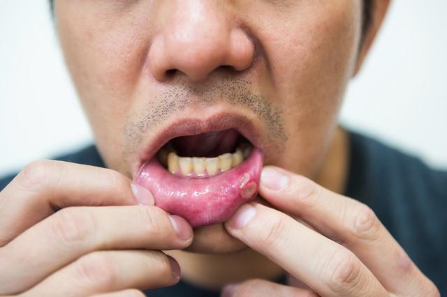 口腔溃疡无需特别用药