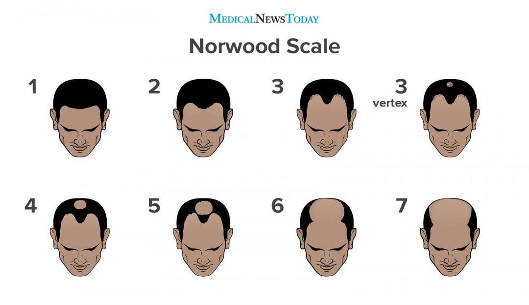 雄激素源性脱发的分期，男性型脱发分为7个阶段。.jpg