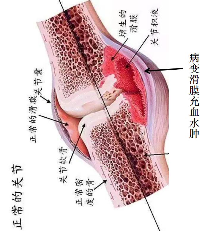 膝关节这一病痛易反复发作！医师给出多种治疗方法