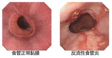 反流性食管炎内镜表现.png